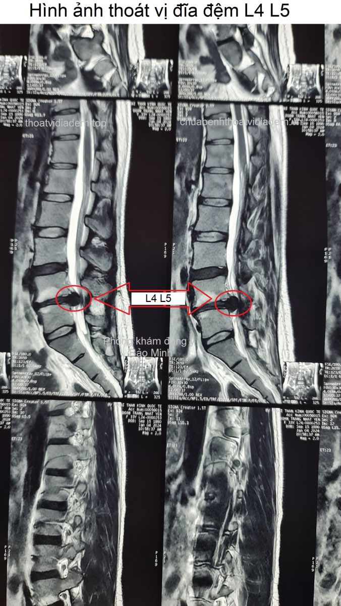Hình ảnh thoát vị đĩa đệm L4 L5